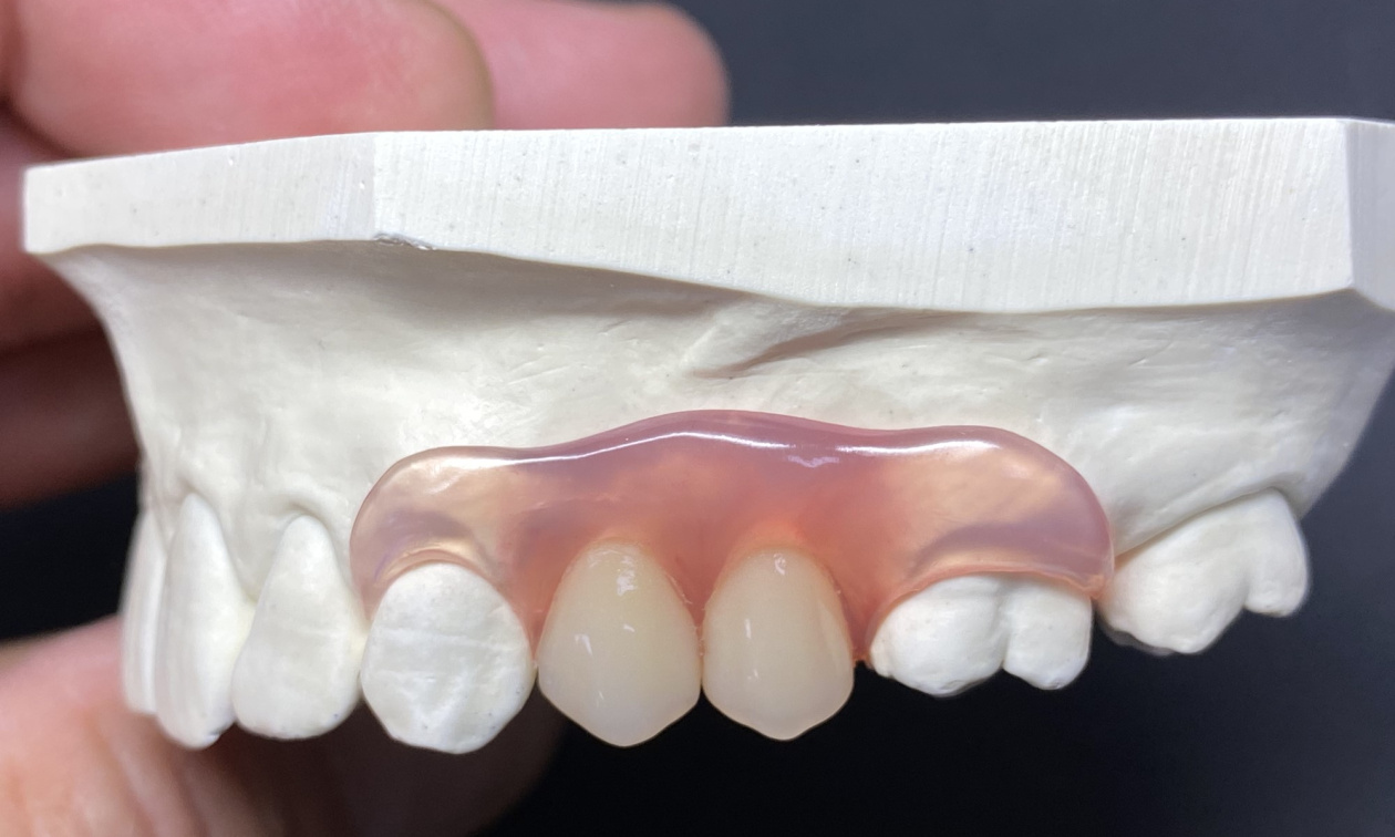 Puro.flexx-Prothese für den Ersatz der Zähne 24 und 25 mit flexiblen Klammern an 23 und 26